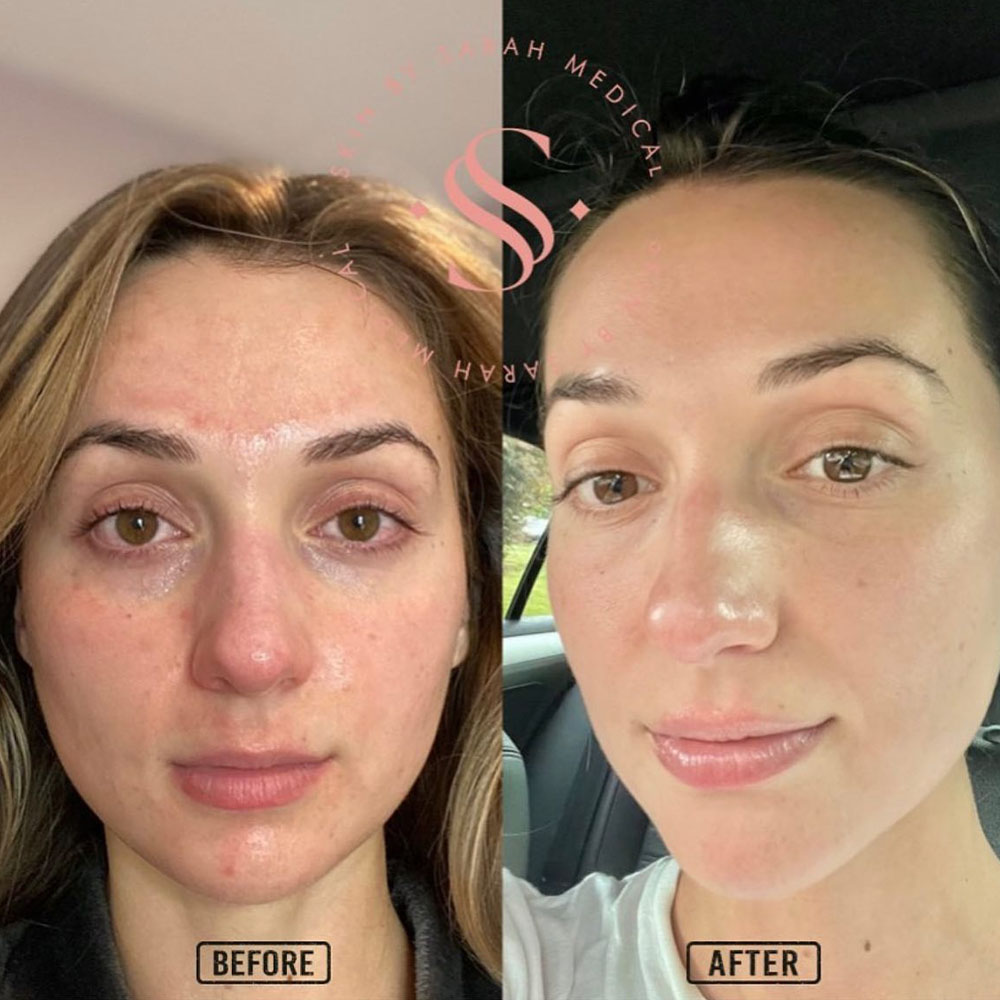 Microneedling with Exosomes Before and After Results