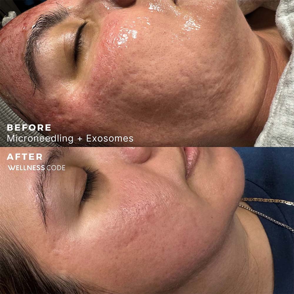 Microneedling with Exosomes Before and After Results