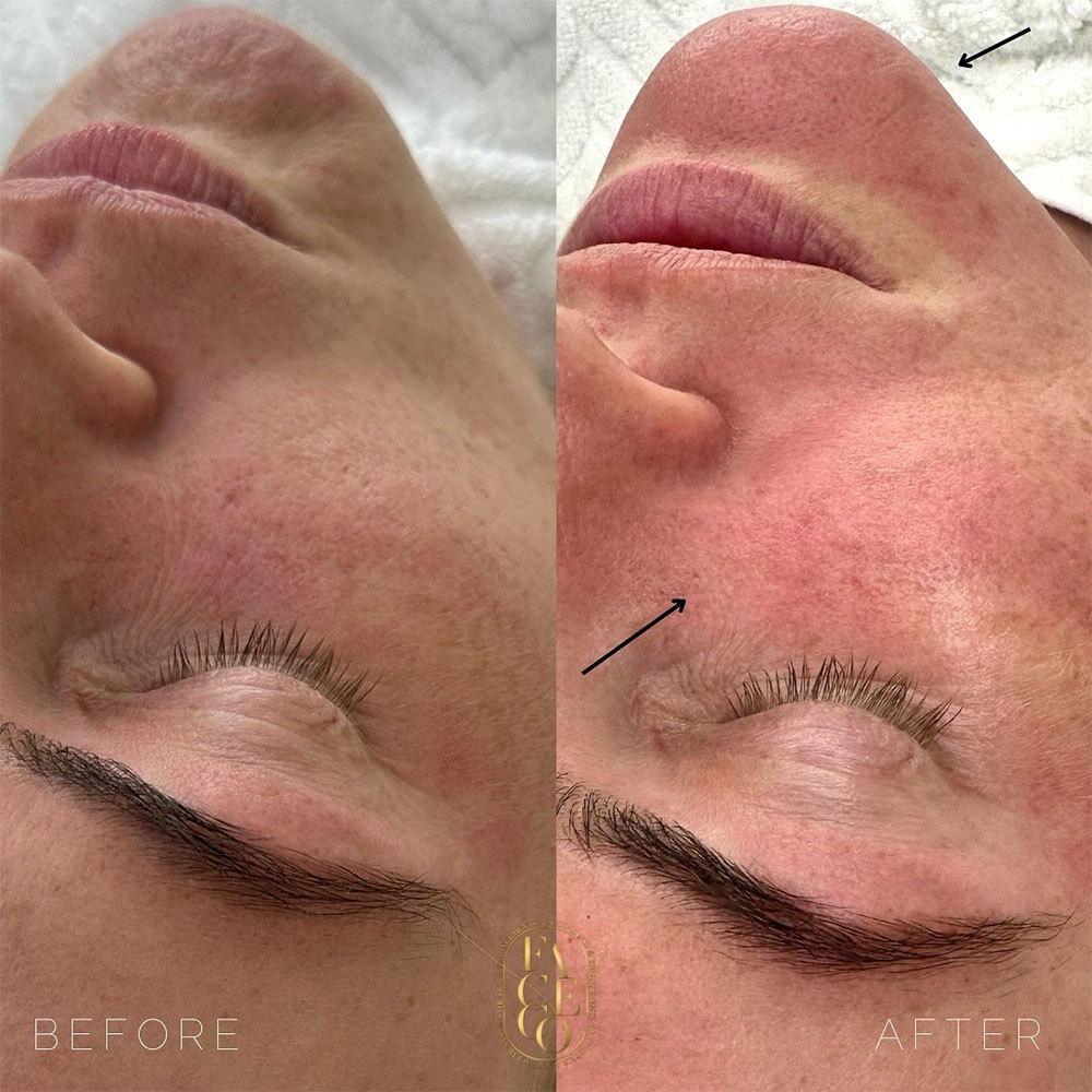 Microneedling with Exosomes Before and After Results
