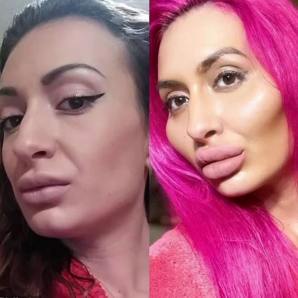 bad cheek filler