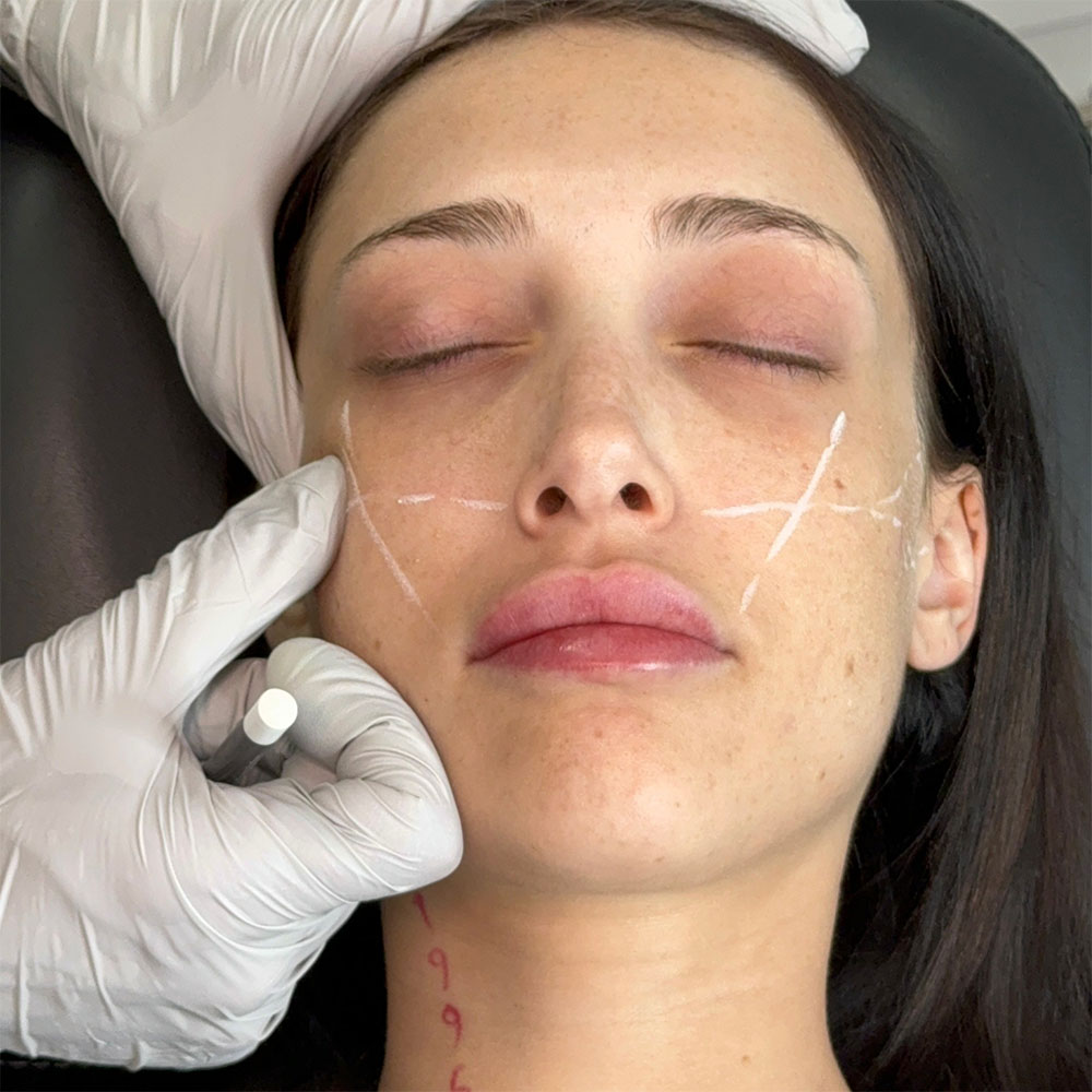 Cheek Filler Injection Points