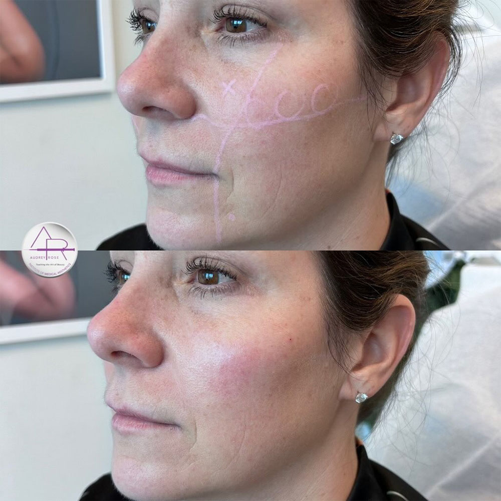 Cheek Filler Injection Points