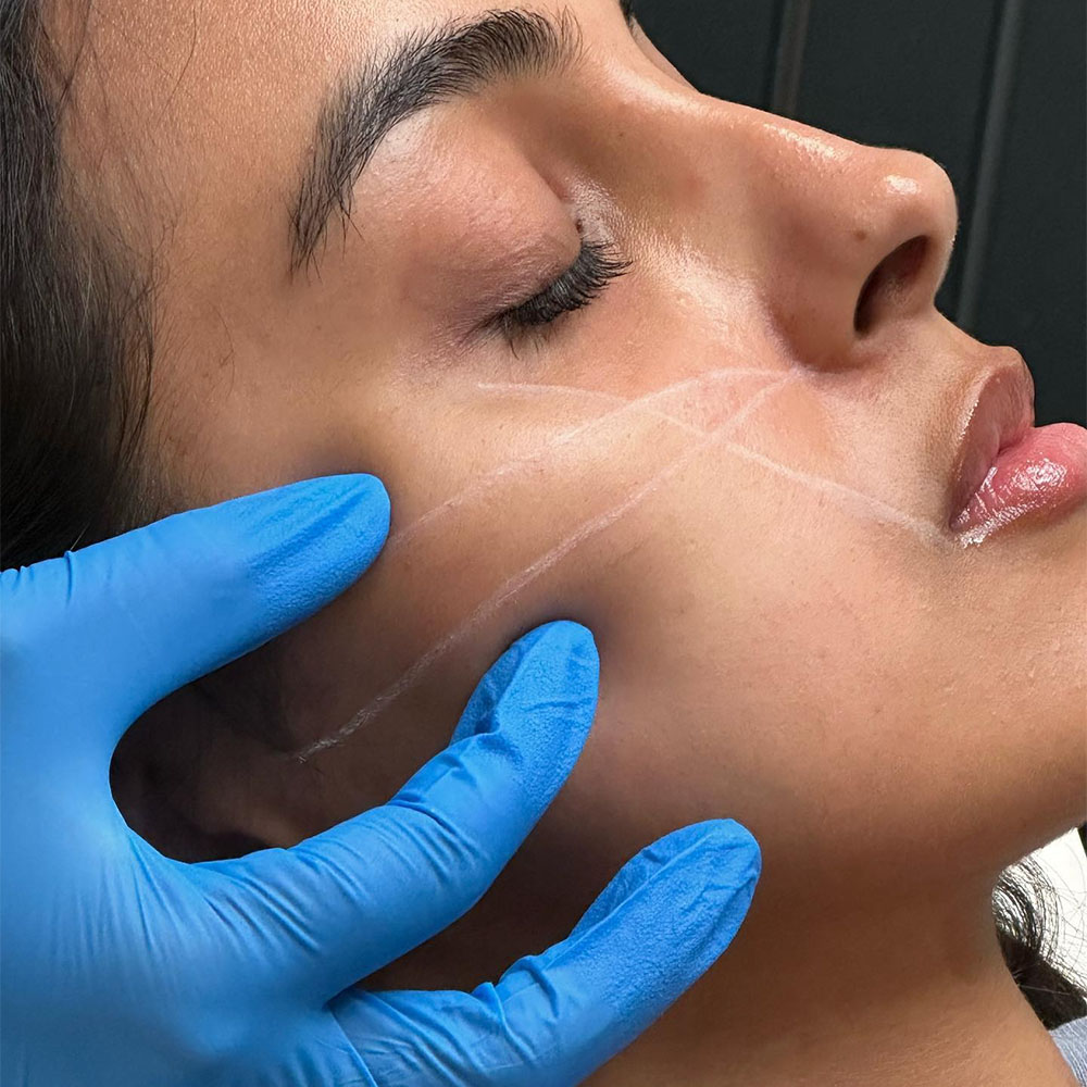 Cheek Filler Injection Points