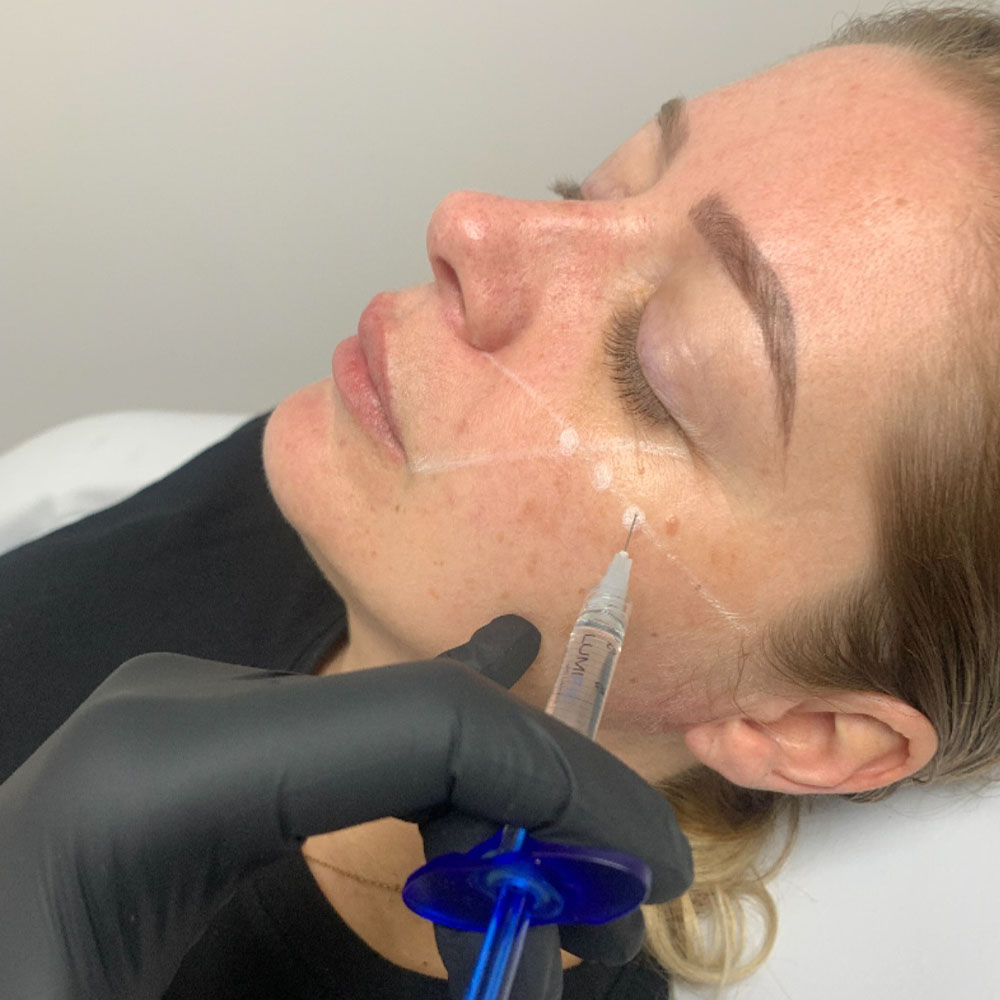 Cheek Filler Injection Points