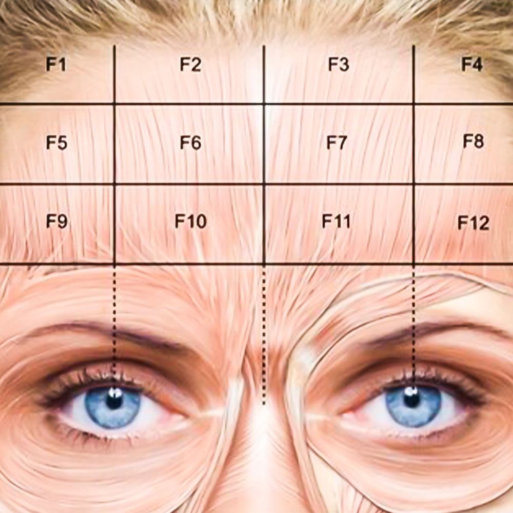 botox forehead injection sites