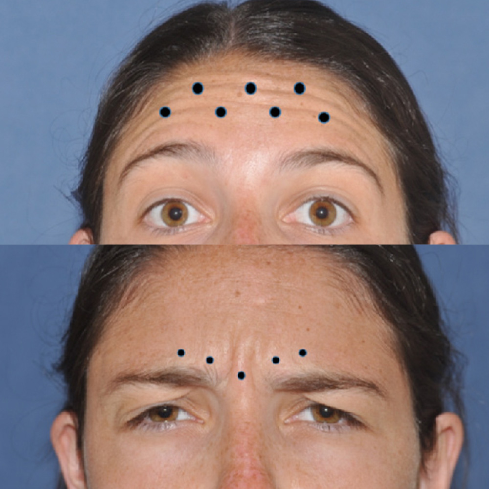 botox forehead injection sites