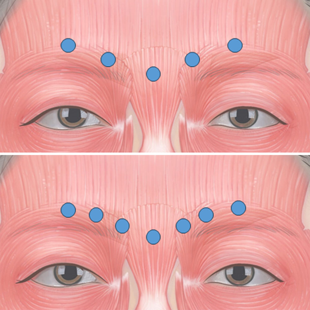 botox forehead injection sites