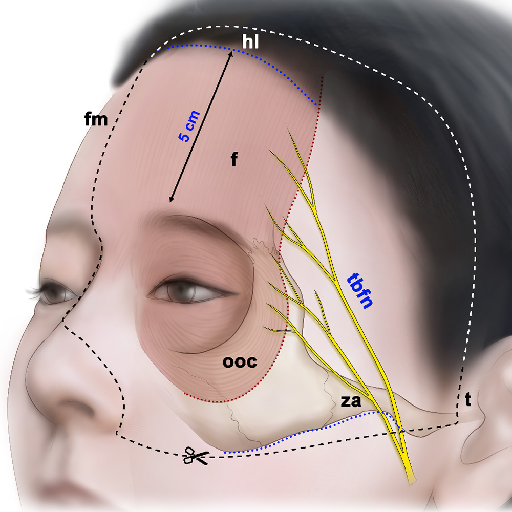 botox forehead injection sites