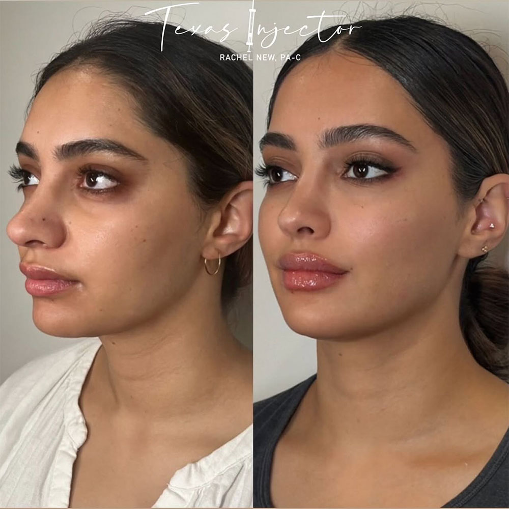 how long does cheek filler take to settle