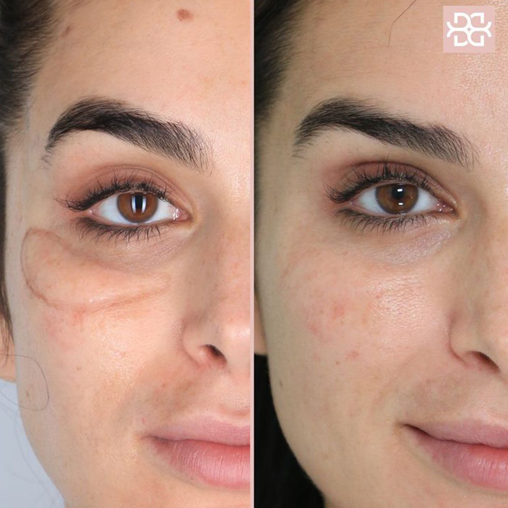 dissolving cheek filler before and after