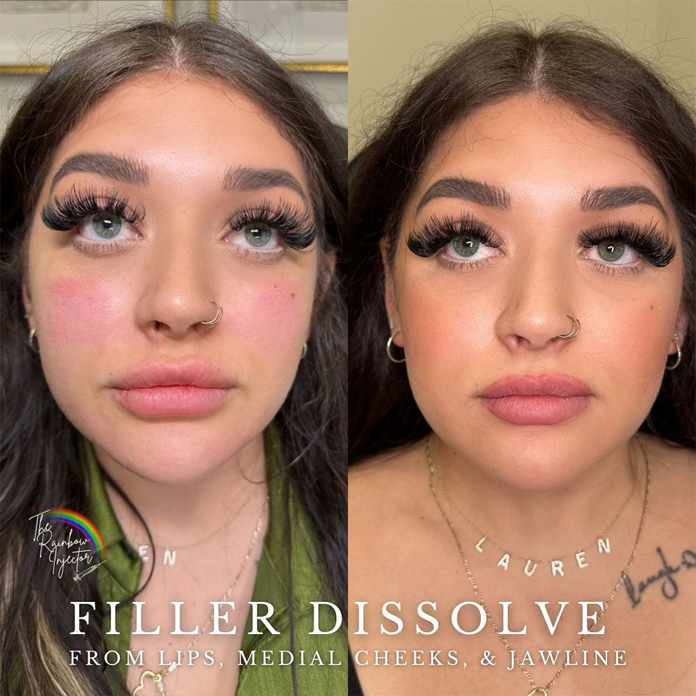 dissolving cheek filler before and after