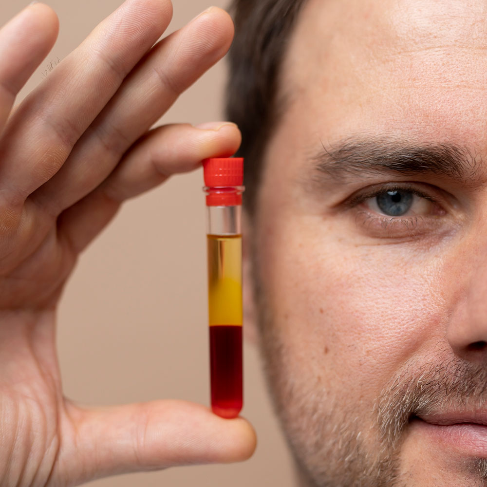 PRP for hair loss before and after​