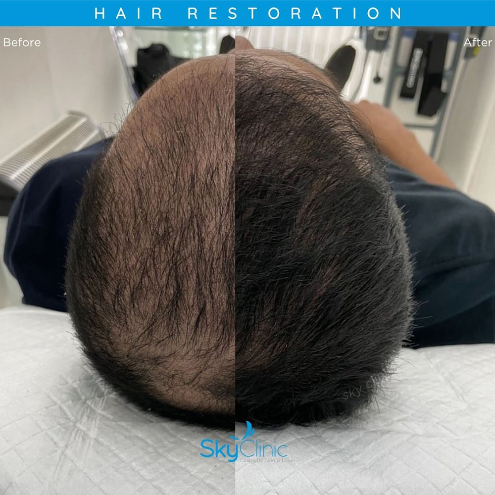 PRP for hair loss before and after​