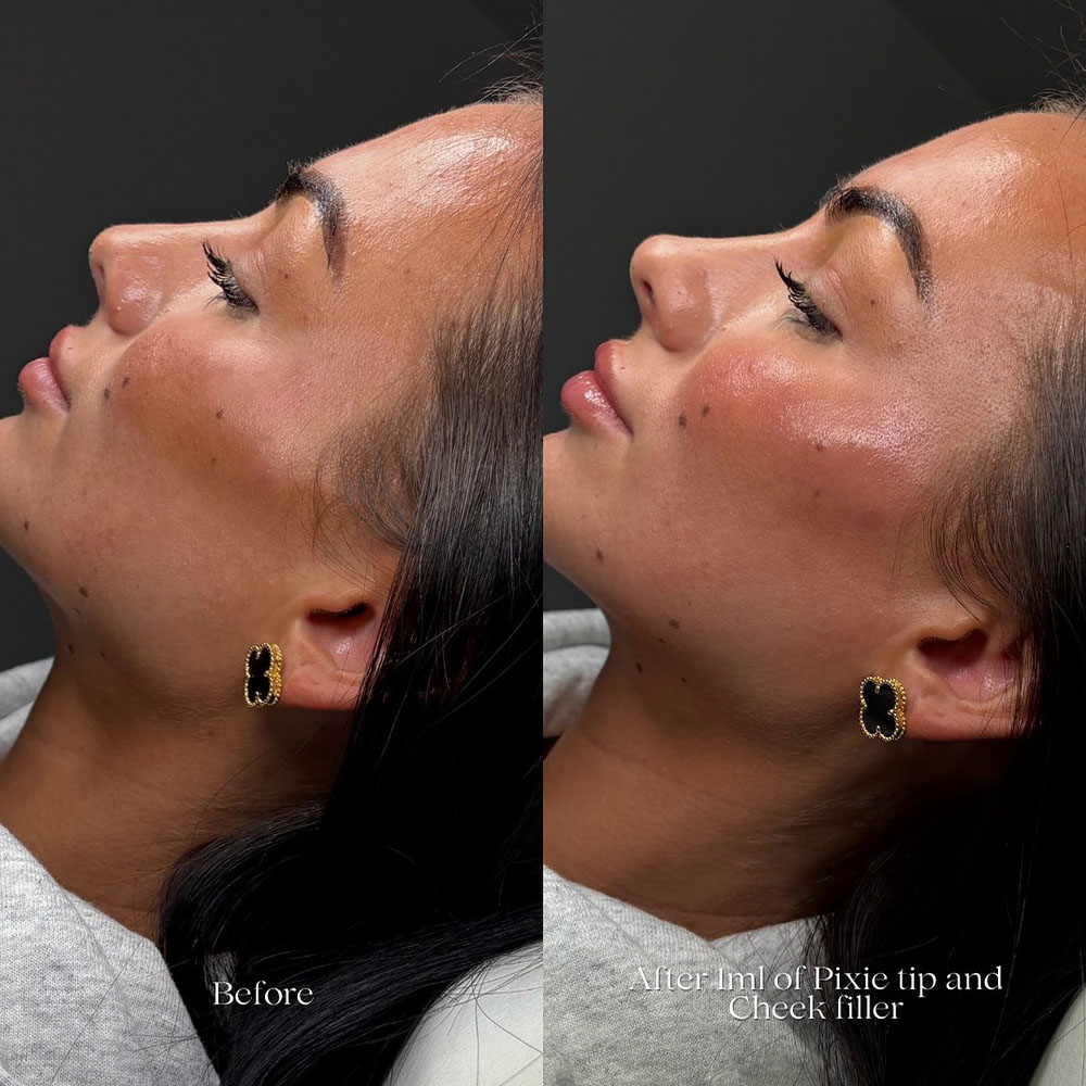 how long does cheek filler take to settle