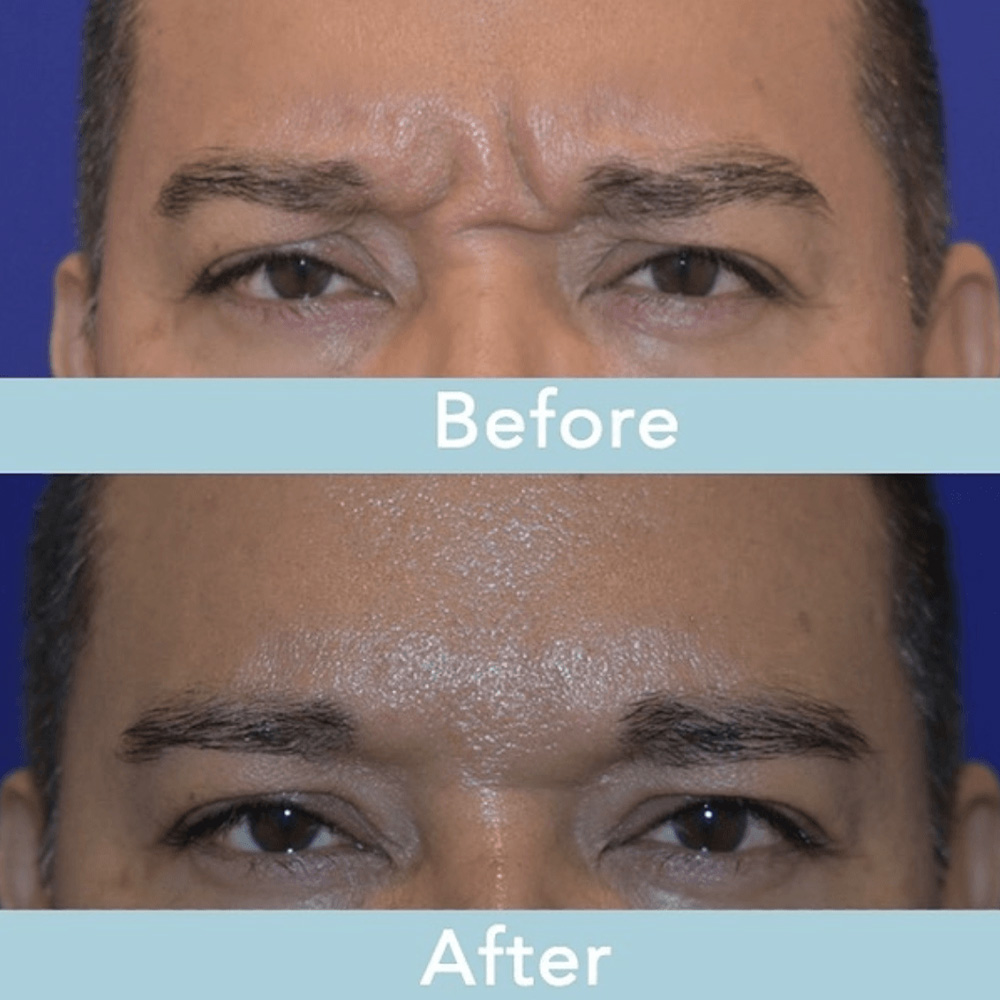 male botox before and after