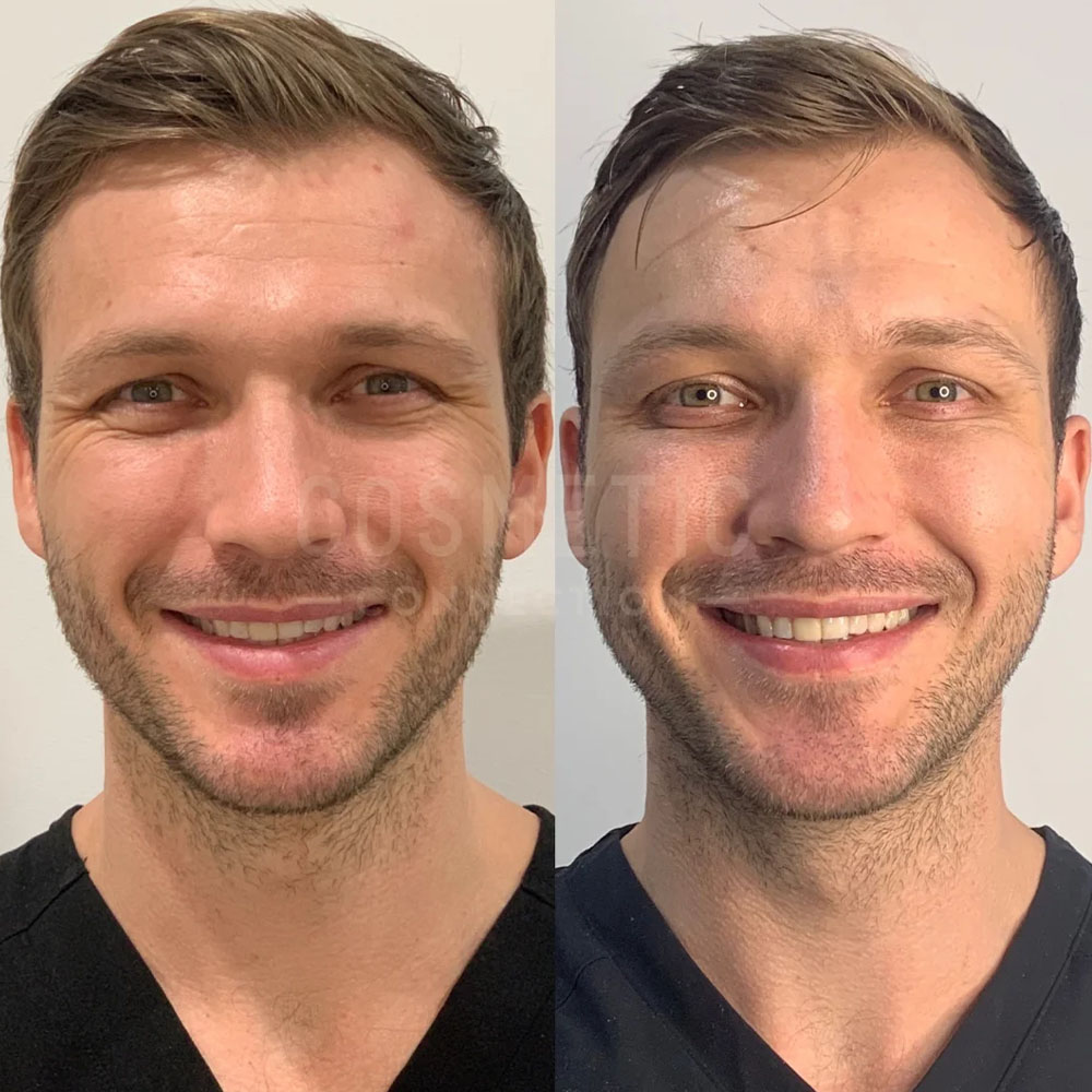 male botox before and after