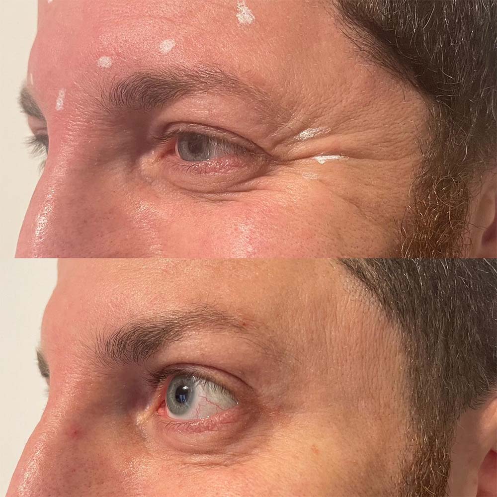 male botox before and after