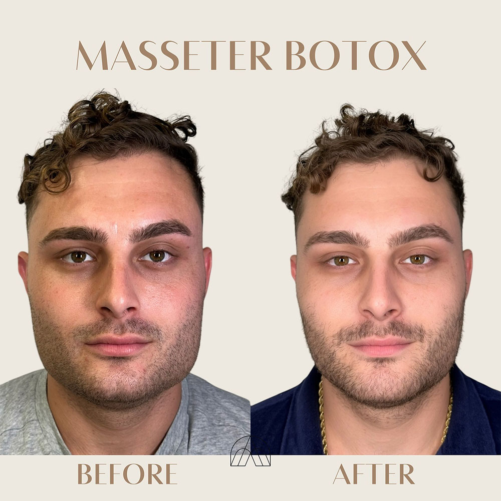 male botox before and after