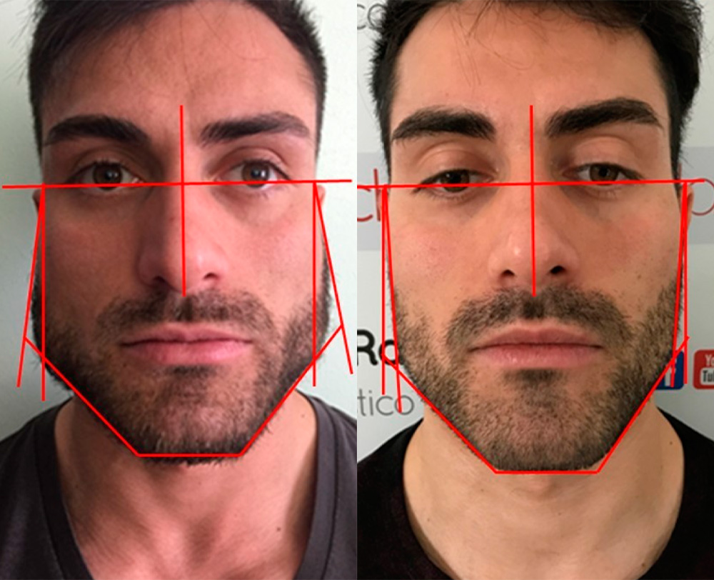 male botox before and after