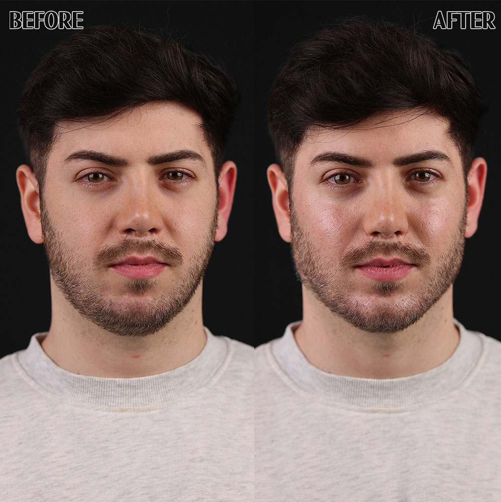 Men Cheek Filler