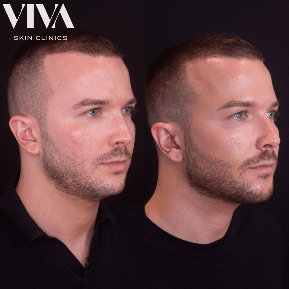 Men Cheek Filler