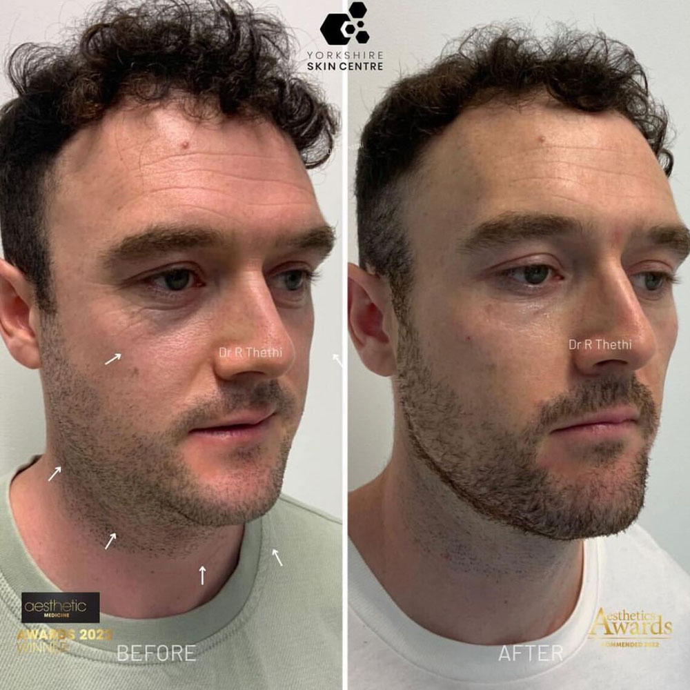 Men Cheek Filler