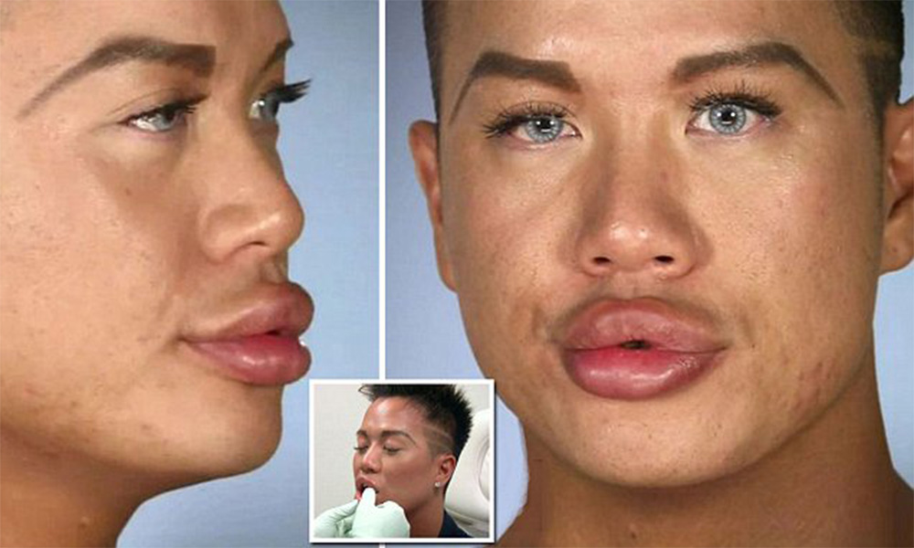 dermal fillers men