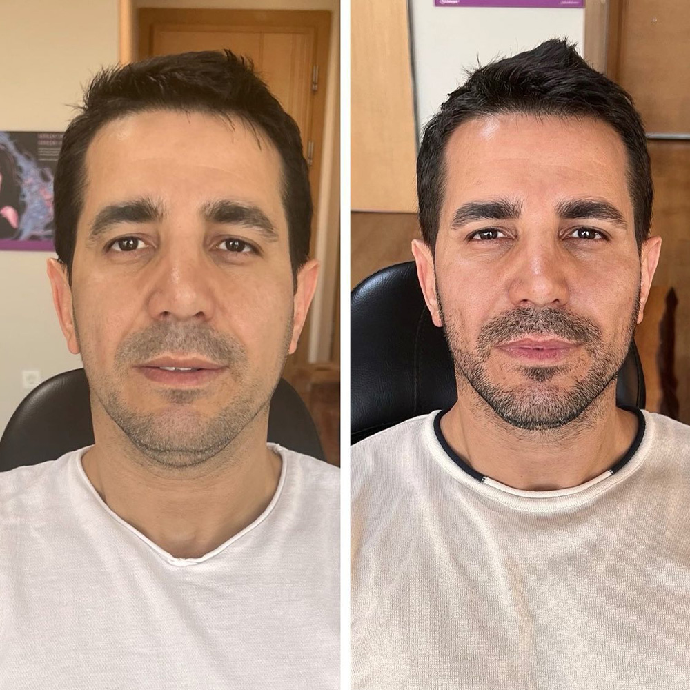 dermal fillers men
