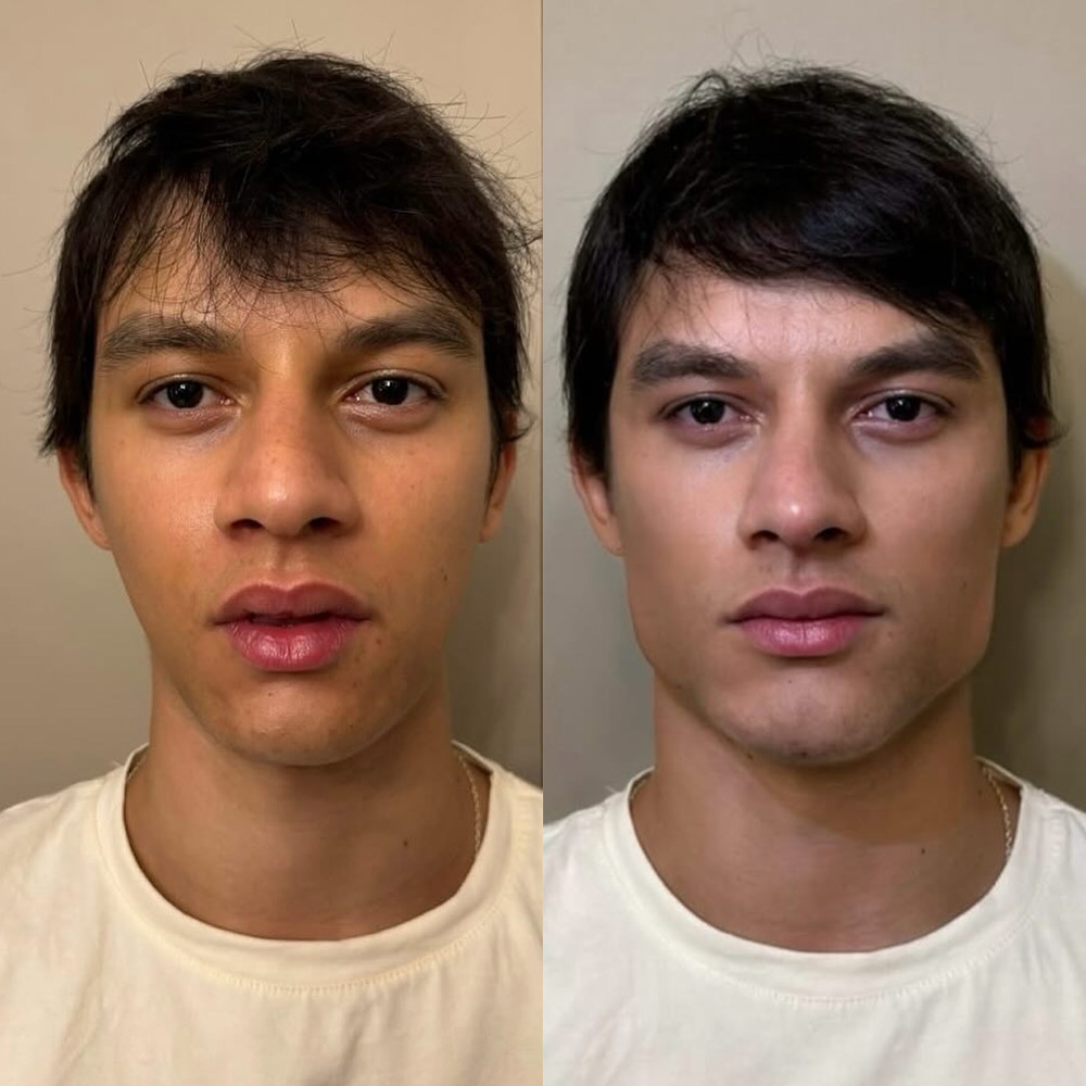 dermal fillers men