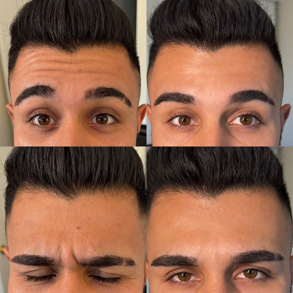 Botox for men