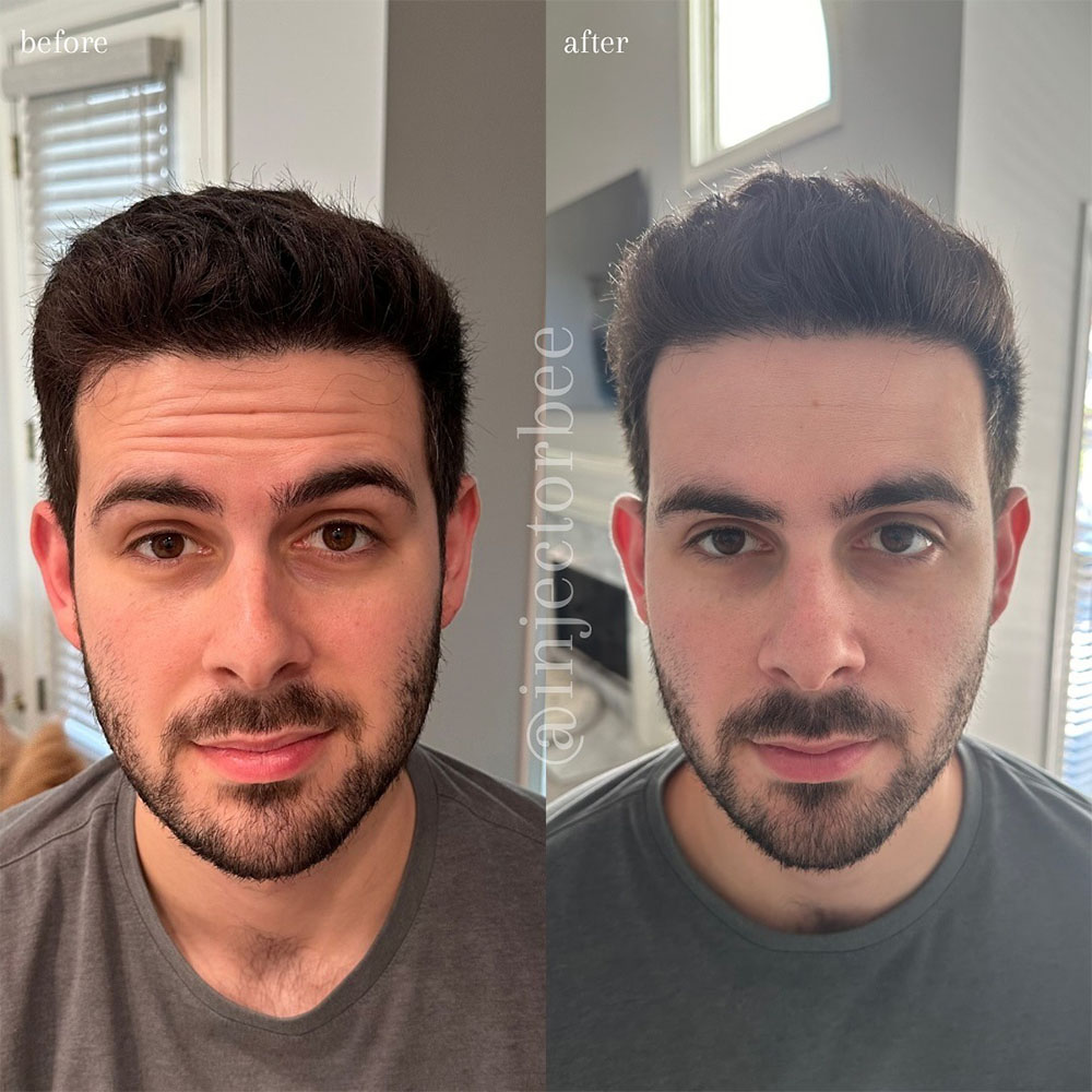 Botox for men