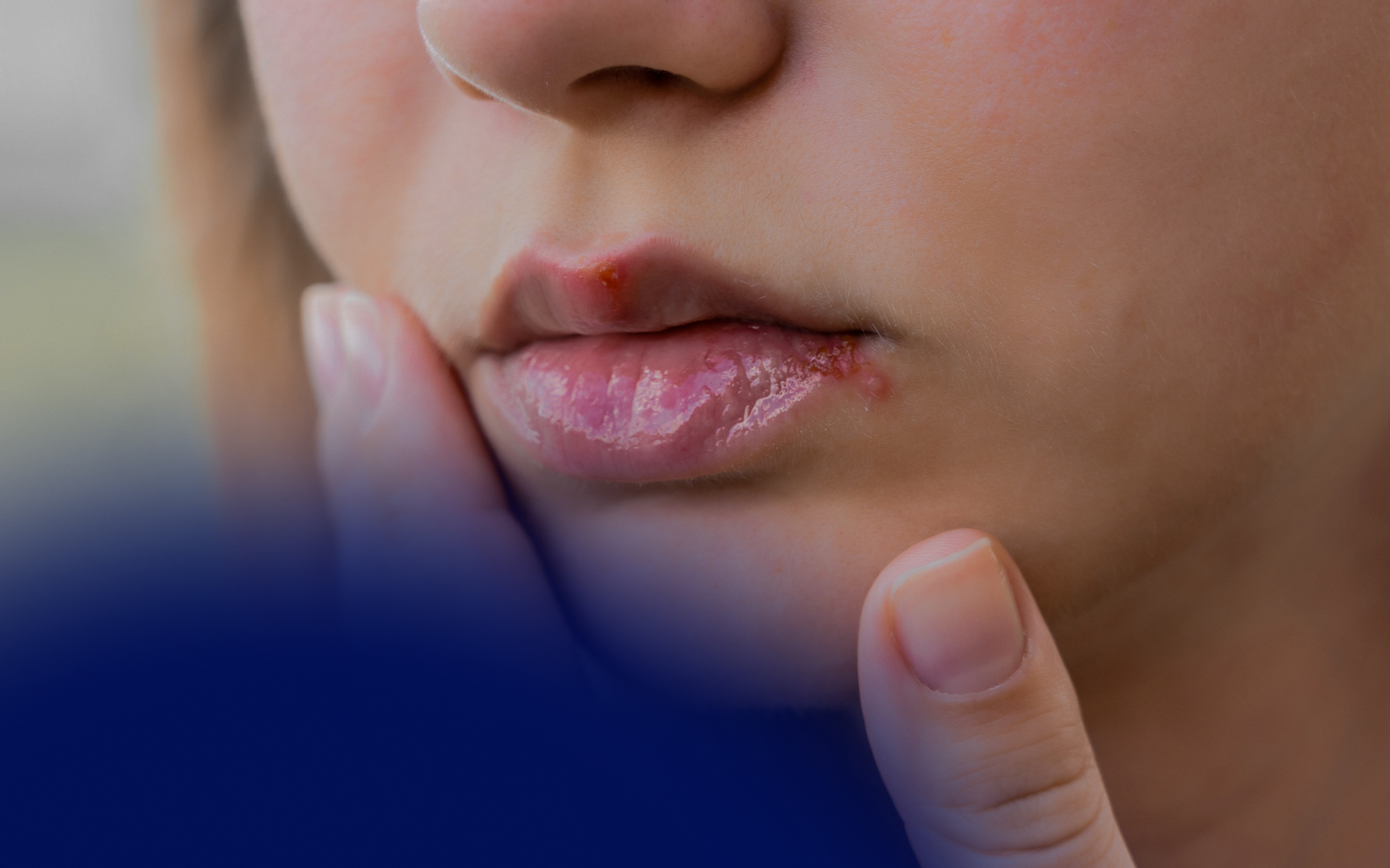How to Recognize and Treat Allergic Reaction to Lip Filler