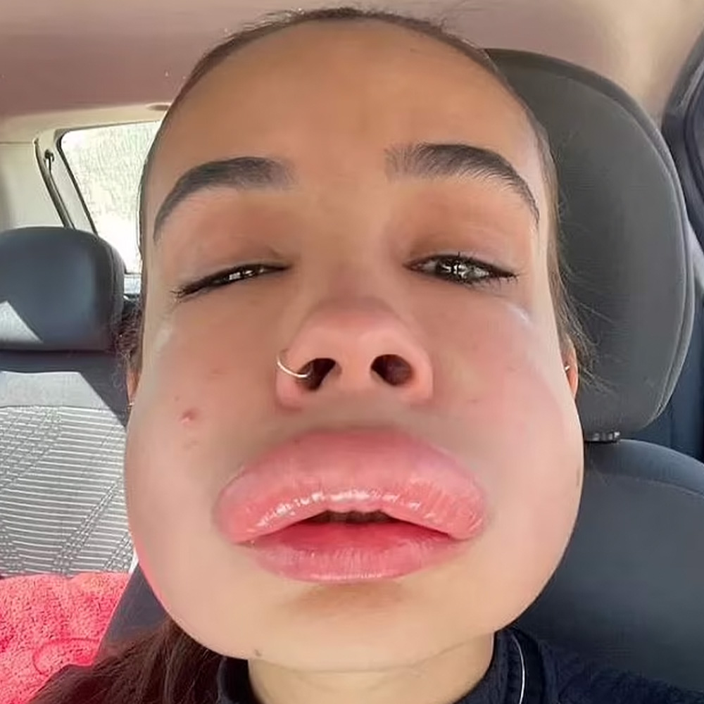 allergic reaction to a product designed to dissolve lip filler
