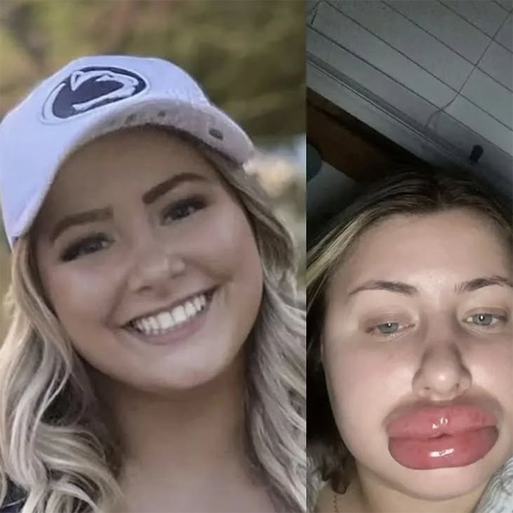 allergic reaction to lip filler