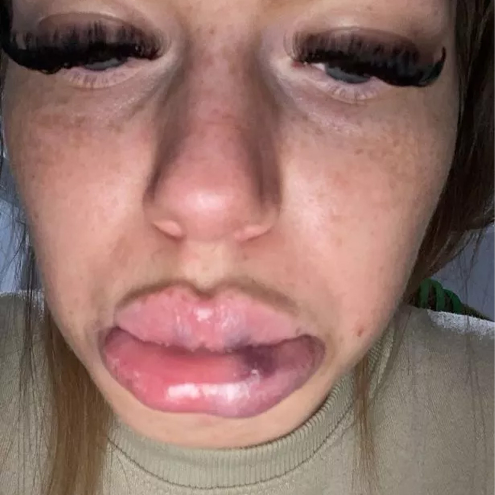 lip filler allergic reaction