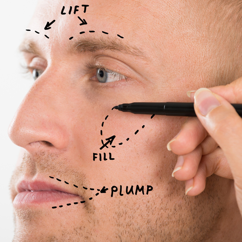 male cheek augmentation