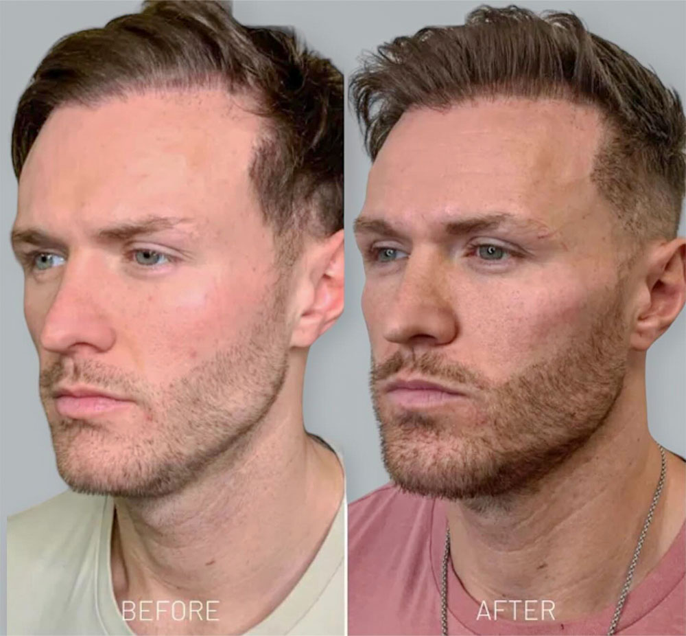 male cheek augmentation