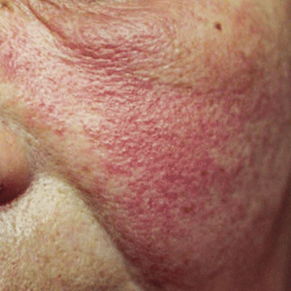male cheek augmentation