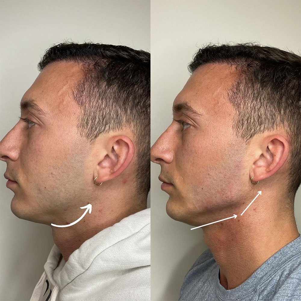 jawline filler men