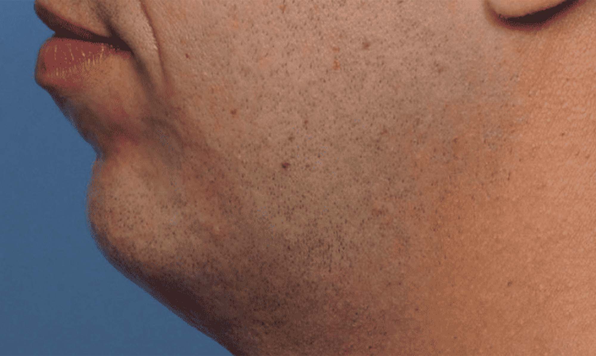 male chin filler