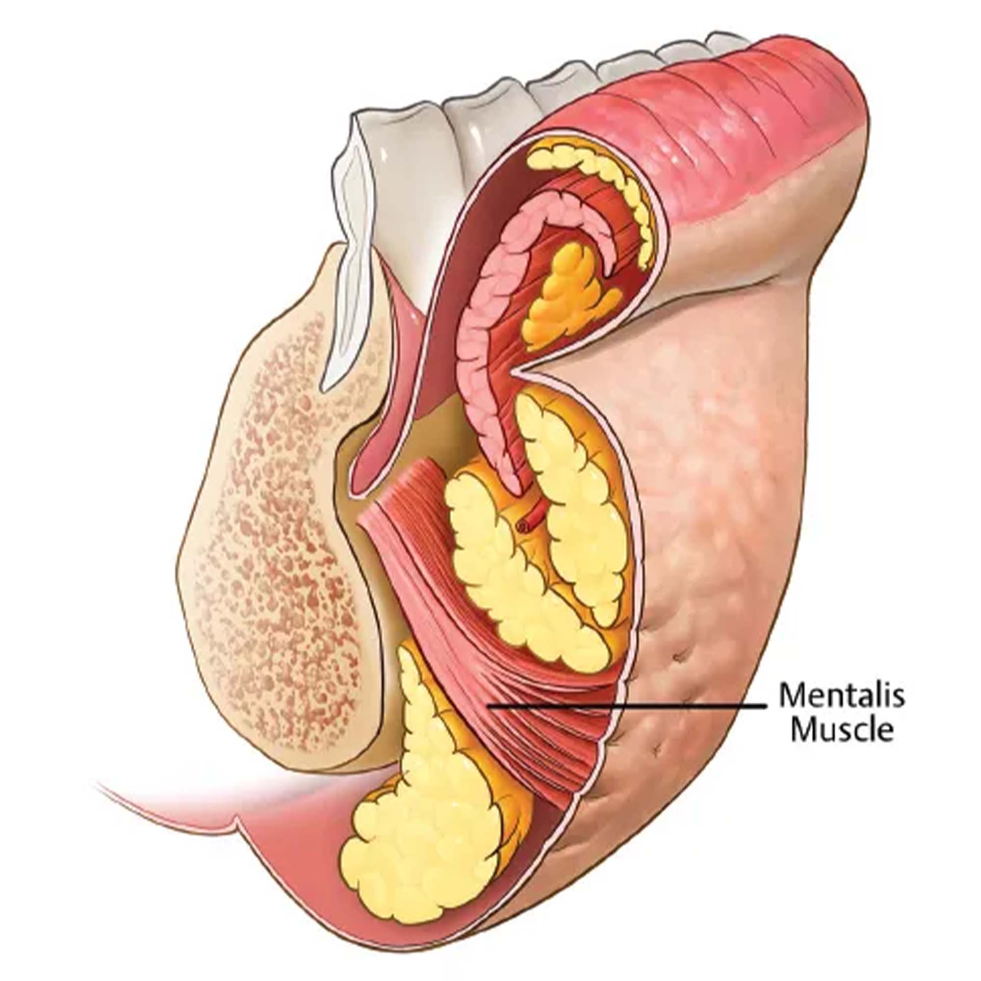 male chin filler