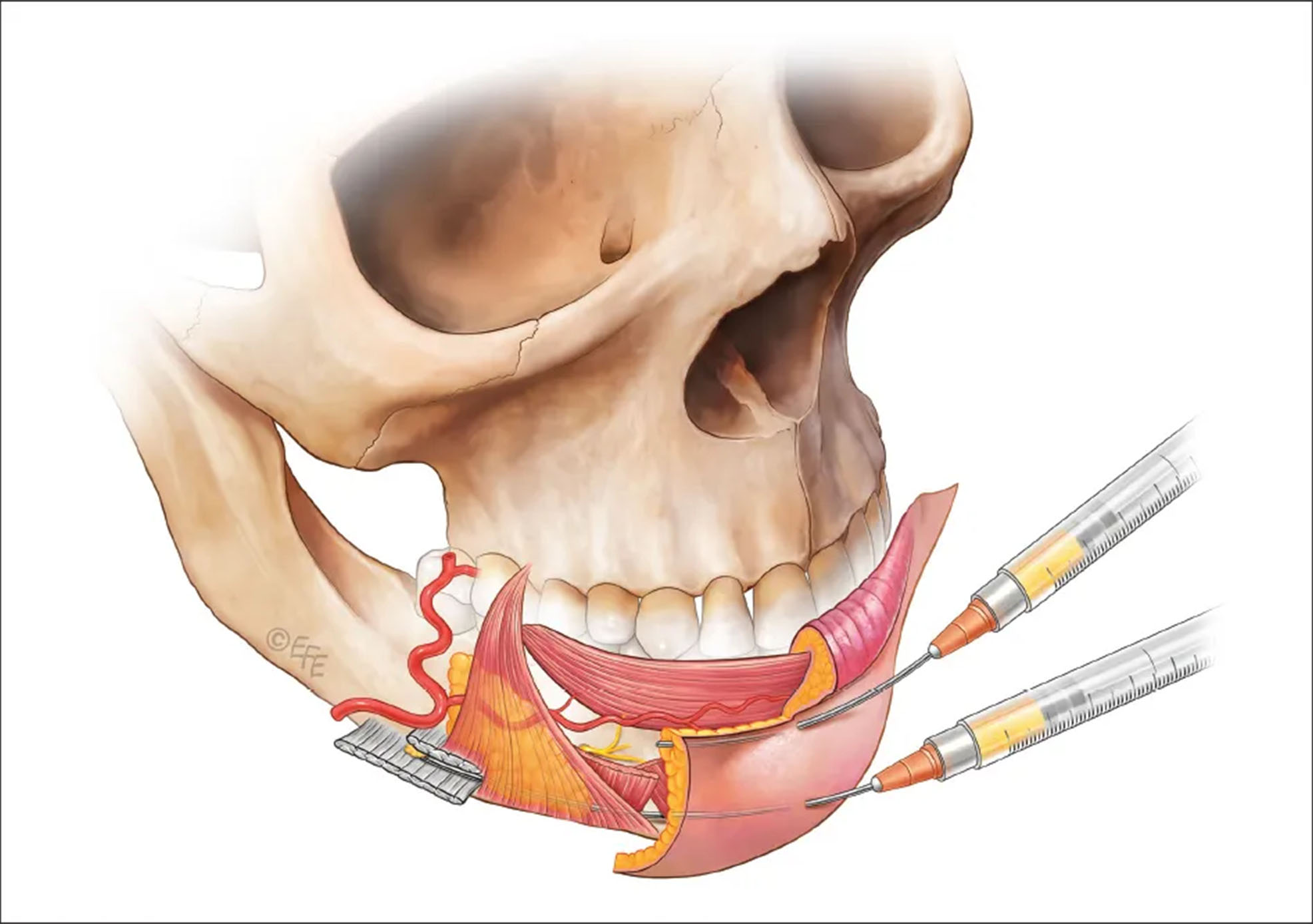 male chin filler
