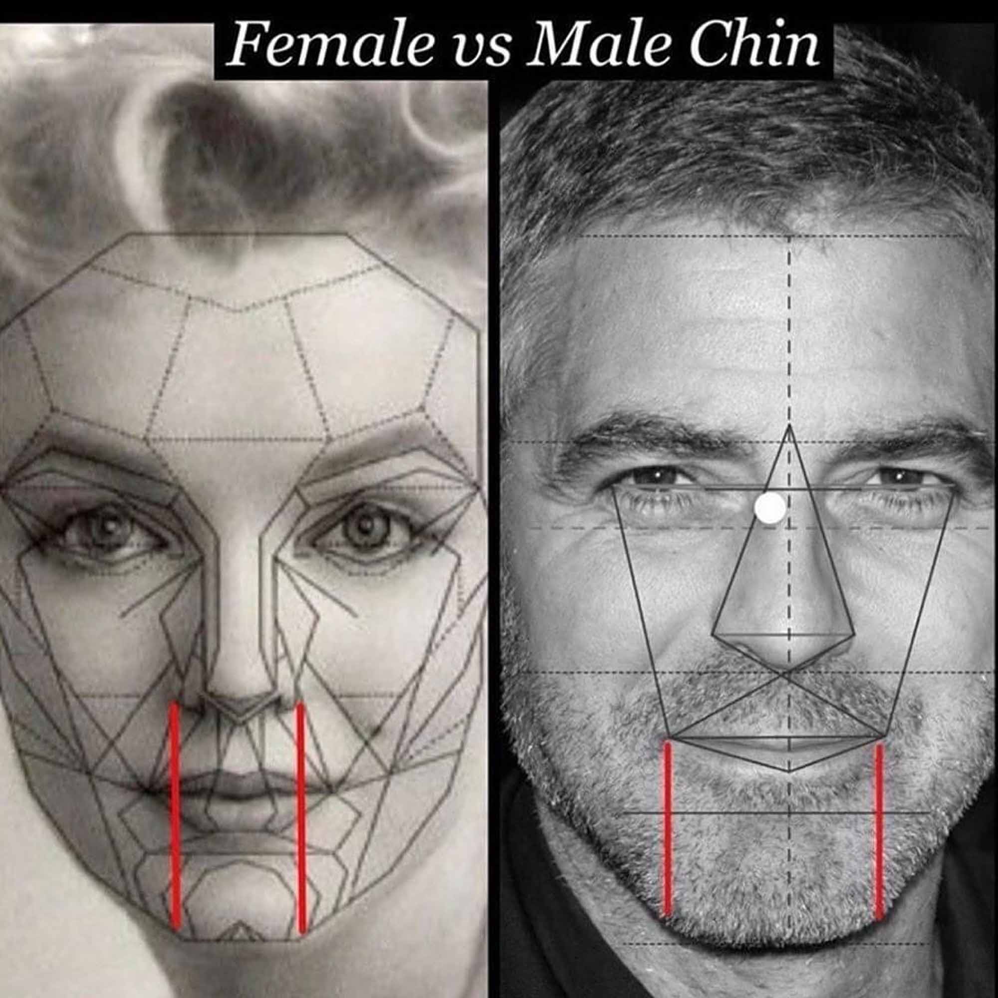 male chin filler