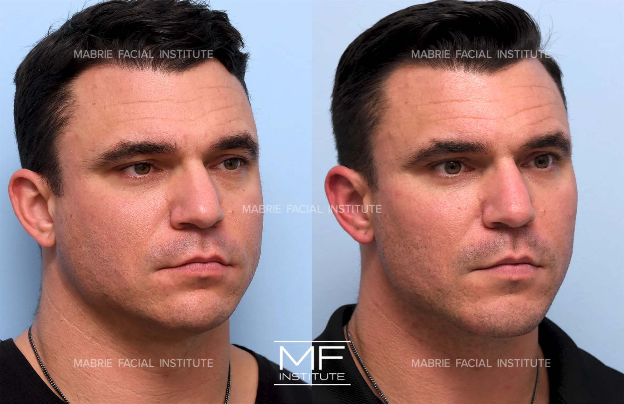 male chin filler