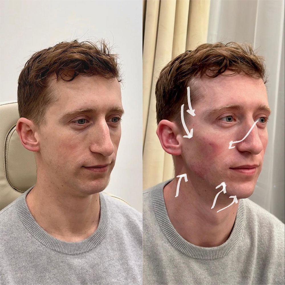 male facial sculpting