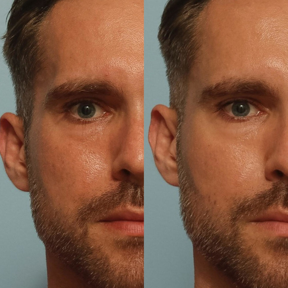 male facial sculpting