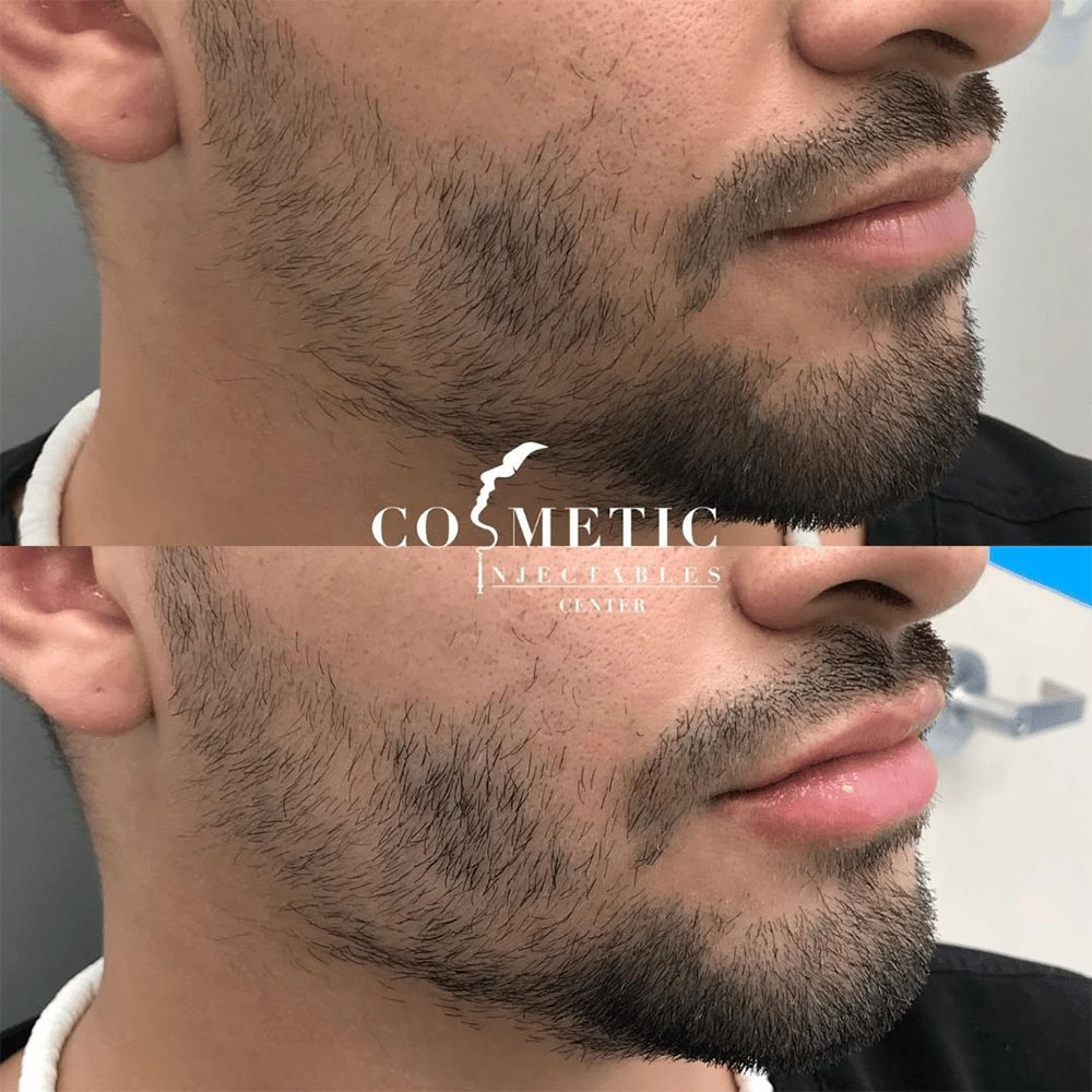 male facial sculpting