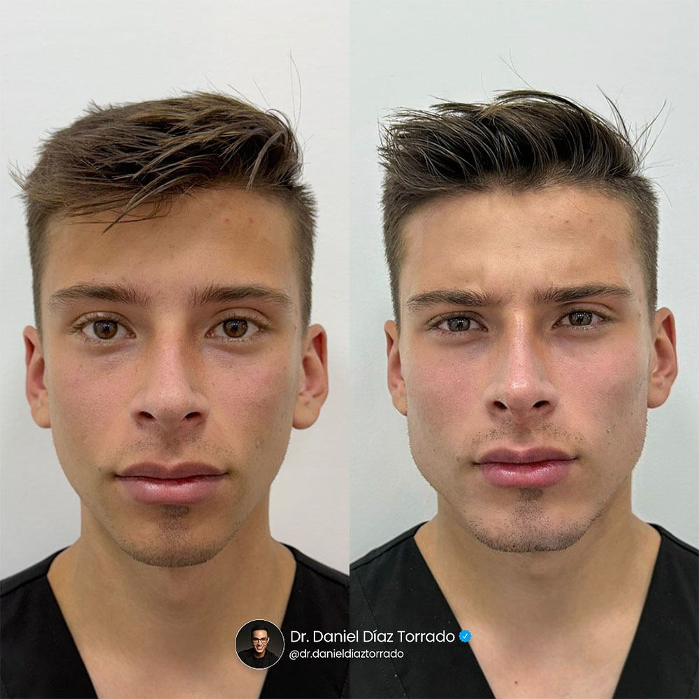 facial masculinization