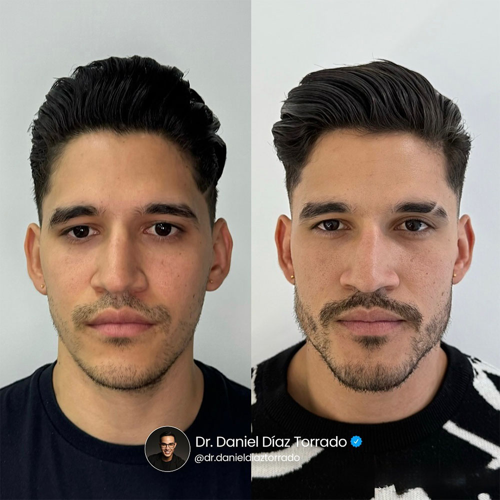 facial masculinization fillers
