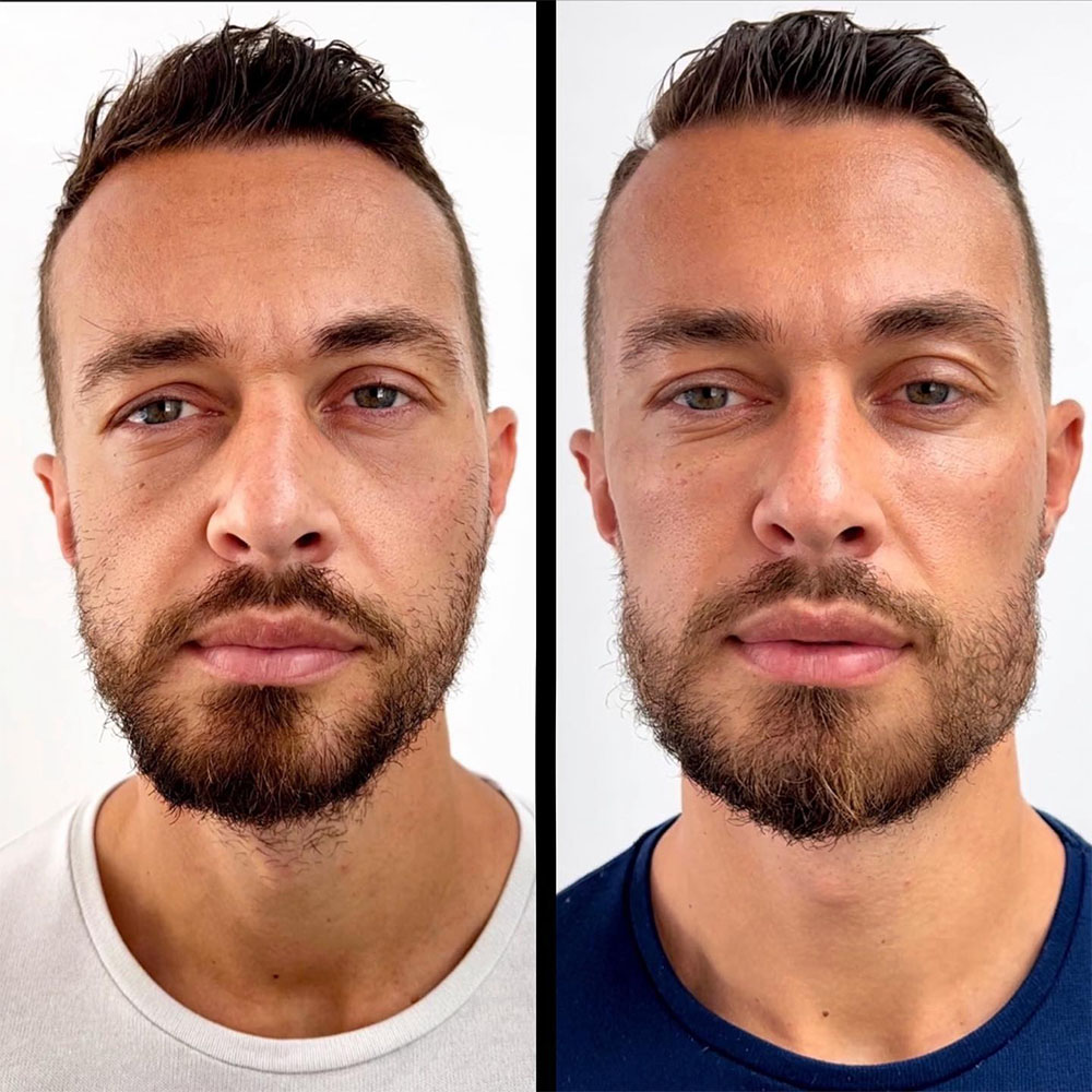 facial masculinization fillers